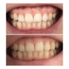5D Whilte dantų balinimo juostelės